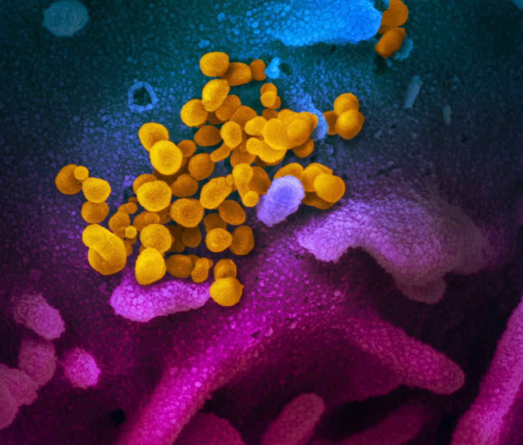 canning electron microscope image shows SARS-CoV-2 (yellow) viral infection—also known as 2019-nCoV, the virus that causes COVID-19  cannabis cannabinoids